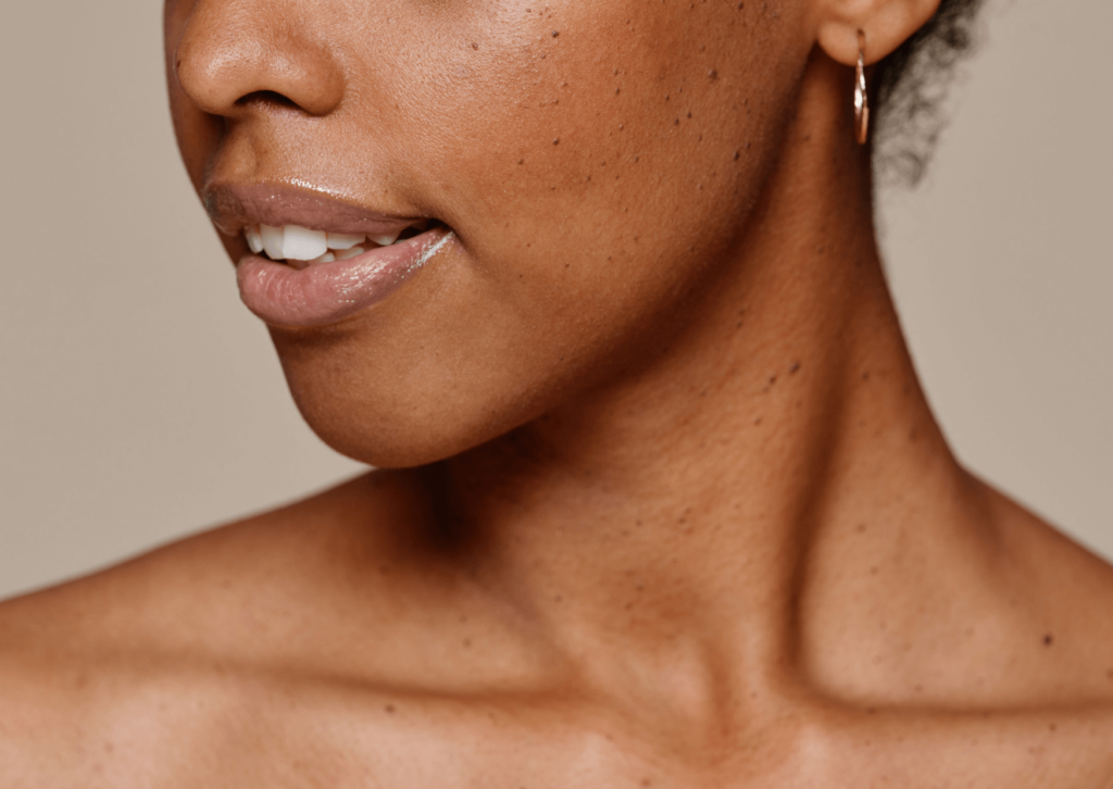  Taches hyperpigmentation peau noire